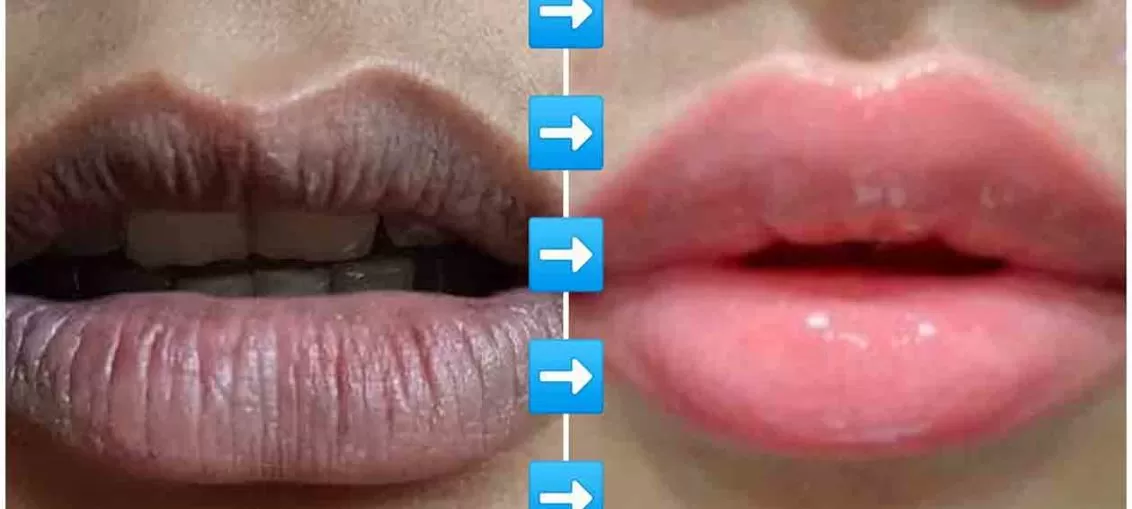 ঠোঁটের কালো দাগ দূর করার উপায়