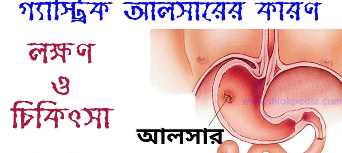 আলসার, গ্যাস্ট্রিক আলসারের কারণ, লক্ষণ ও চিকিৎসা