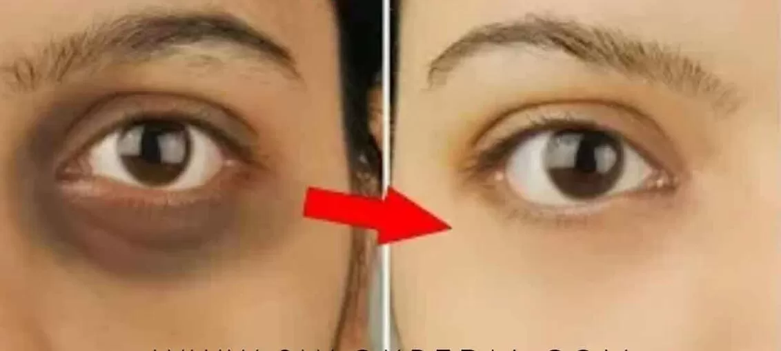 চোখের নিচে কালো দাগ দূর করার ঘরোয়া পদ্ধতি, চোখের কালি দূর করার উপায়